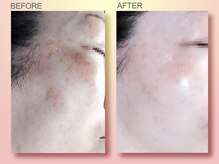 ジュリア オージェ 難波店/ビフォーアフター（シミケア）