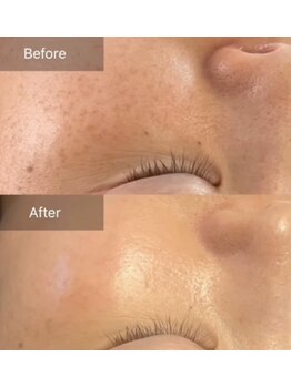 ベリッシマ(Bellissima)/シミ改善も得意です♪