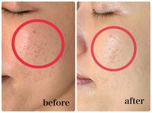 ルボヌール(Le Bonheur)/美容液導入でお悩み改善