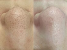 スア(SUA)の雰囲気（ハイドラ+LEDライト照射1回施術無加工before→after）