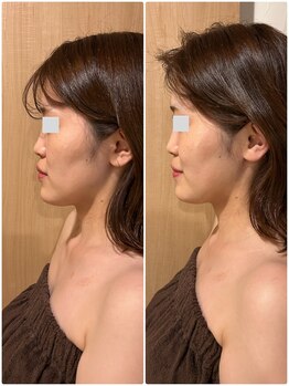 アグレア(Agrea)/頭蓋骨小顔矯正1回の施術♪