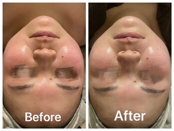 サロンモリ(Mori)/1回でも効果実感!赤ら顔改善◎