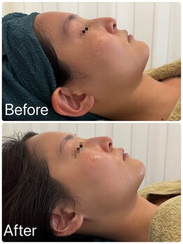 サロンドフェイス(Salon de Faith)/コルギ+エニシーグローパック2回