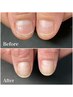 【人気NO.1!!】深爪矯正/地爪育成ケア.クリア5回コース¥¥49,500→