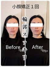 リバイブ 自由が丘店(REVIVE)/小顔矯正+ドライヘッドスパ1回