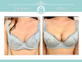 美人バスト アンド ヒップアップ 広島店/バストアップ症例写真