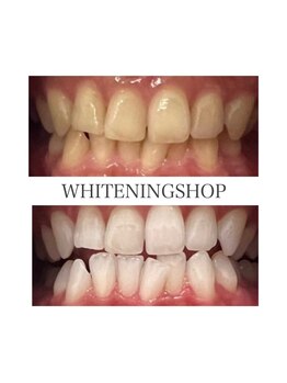 ホワイトニングショップ 徳島店/Before&After美白ホワイトニング