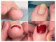 モノ。コト。時々ネイル。 bricoの写真/巻き爪矯正や魚の目等のフットケア専門サロン◆ずっと隠していた足元のお悩みを解消し見惚れる足先へ♪