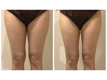 エイシスグロウ(asis glow.)/効果写真