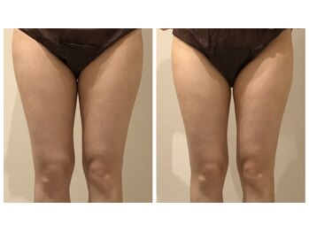 エイシスグロウ(asis glow.)/効果写真