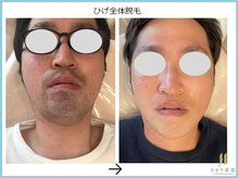 ひかり素肌の雰囲気（特に結果に自信あり！違いが分かる写真も多数有☆[脱毛/メンズ]）