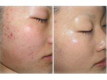 ビソウ(Biso)/ハーブピーリング