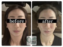 キュープ 小倉店(Qpu)/美顔器コース４回での変化