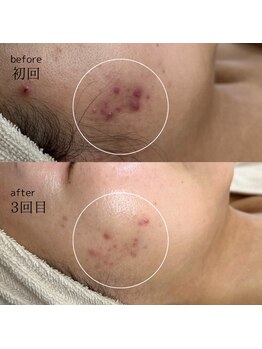 セン(Sen)/ビフォー＆アフター