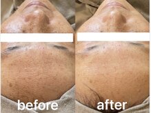 イリゼ(iriser)/ハーブピーリングBeforeAfter