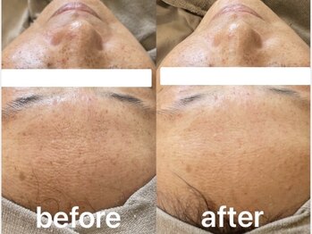 イリゼ(iriser)/ハーブピーリングBeforeAfter