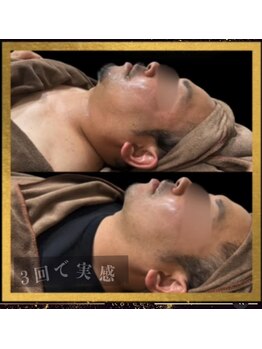 ラフィール/小顔ケア