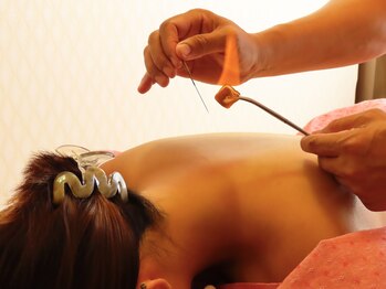 プロぺ鍼灸整骨院/希少！効く！火鍼[鍼灸/所沢]