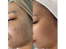 【剥離なしハーブピーリング】 ニキビや毛穴悩みにオススメ