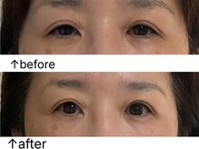 柚香鍼灸院/美容鍼灸ビフォーアフター