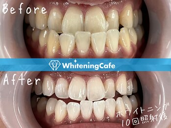 ホワイトニングカフェ 吉祥寺店(WhiteningCafe)/ホワイトニングビフォーアフター