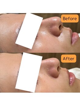 エミュ(emu)/◆毛穴・黒ずみ・皮脂テカリ