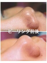 ティアラ(TIARA)/毛穴の黒ずみ解消