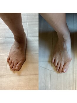 はりきゅう 藤田/半年で足趾の変形の矯正も可能