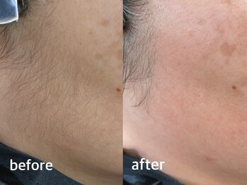 メイクマジック(Makemagic)/お顔全体ワックス脱毛