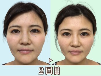 ナチュラルビューティーフェイス 横浜(NBF)/頬骨が変わると余白も狭く/横浜