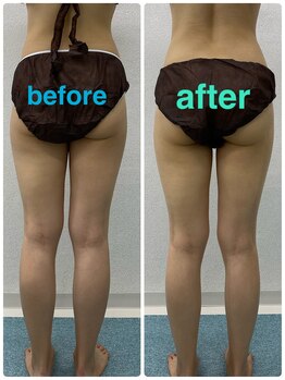 ハロ 南青山(HALO)/キャビラジ全身+太もも脂肪取り