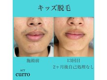 アクト クロ(ACT curro)/【キッズ】脱毛施術例