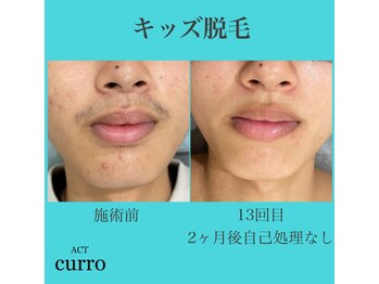 アクト クロ(ACT curro)/【キッズ】脱毛施術例
