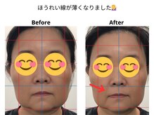 ベル/50代の方の小顔Before After