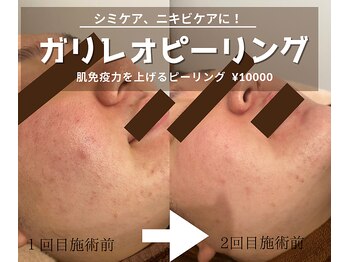 マーヤ(Ma-ya)/シミケア、ニキビケア