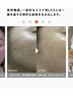 【学割U24】ニキビケア集中コース！