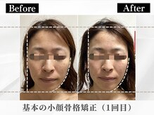 ポーベルポー(Peau Belle poe)/基本の小顔骨格矯正（１回目）