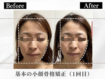 ポーベルポー(Peau Belle poe)/基本の小顔骨格矯正|むくみ