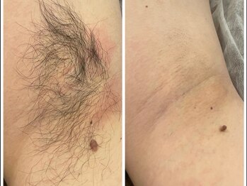 エリクサー 加須店(Elixir)/ワキ脱毛も大人気!