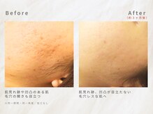 メレ(mele)/20代毛穴／ニキビケア・赤み