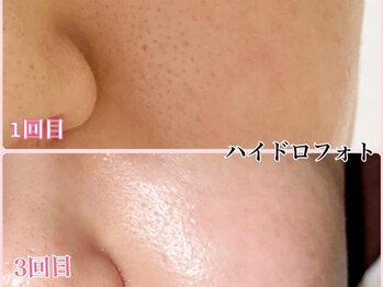 ララン(Laran)の写真/《毛穴をケアした後に光フェイシャルで美肌ケア》