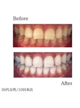 リングベリー 湘南茅ヶ崎(Ring Beauty)/プレミアムホワイトニング施術例