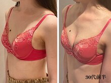 リール 新宿店(RIRE)/30代前半　バストアップ症例