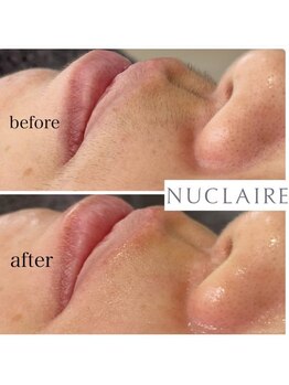 ここはな/お口周りの気になる産毛を綺麗に