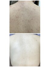 ソリッジ肌管理室/背中ハーブピーリング