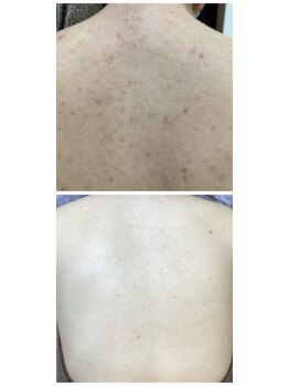 ソリッジ肌管理室/背中ハーブピーリング