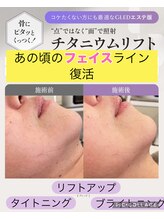 ルース(LUCE)/渡韓いらず☆チタニウムリフト