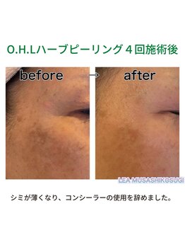 レア 武蔵小杉(LEA)/美肌ハーブピーリング：当店施術