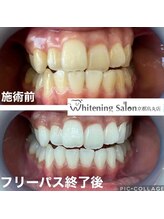 ホワイトニングサロン 京都烏丸店/ホワイトニング施術例
