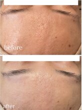 イリゼ(iriser)/ハーブピーリングBeforeAfter